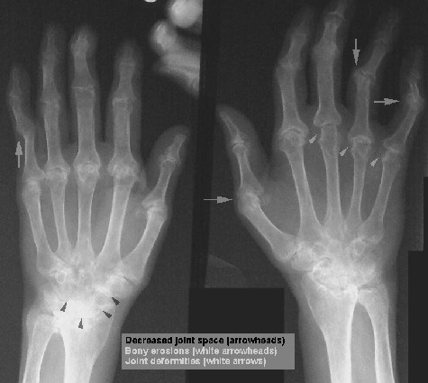 Rheumatoid arthritis